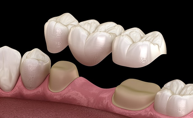 dental bridges