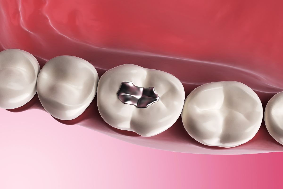 dental filling