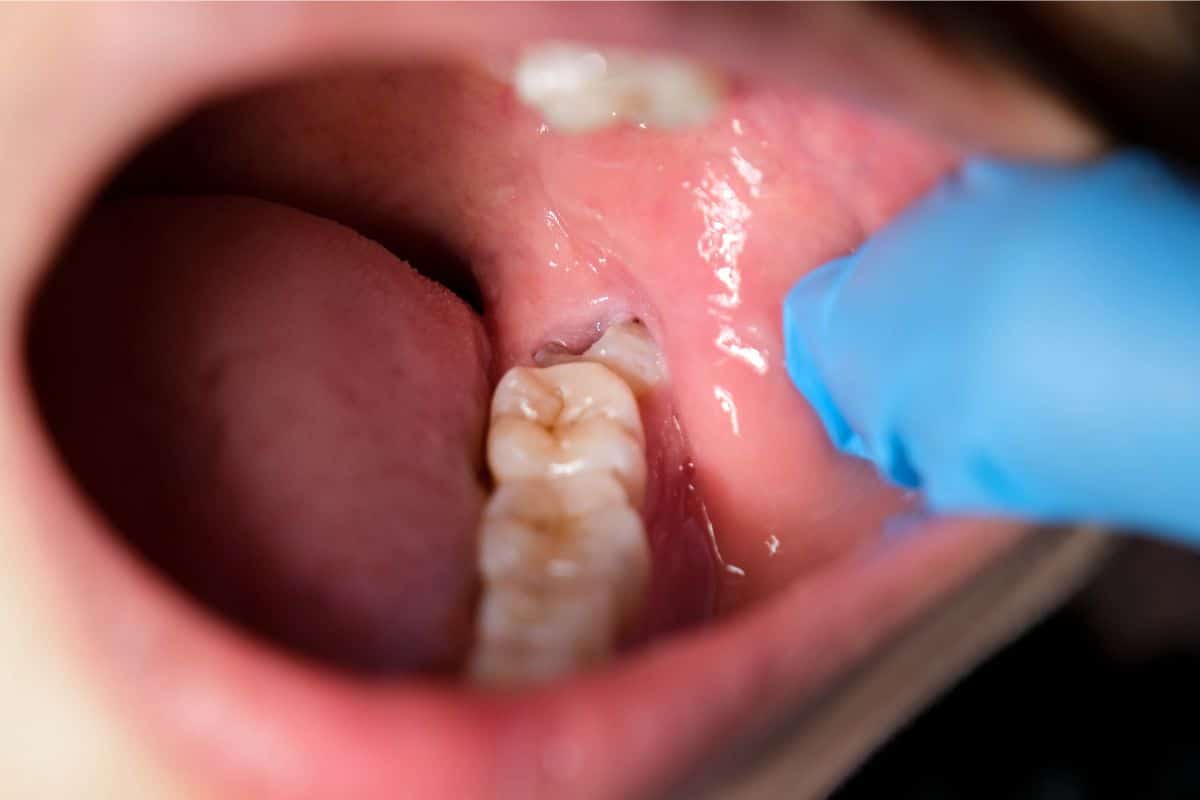 Exposed Tooth Roots Mean for Your Gum Health in Henderson NV at Green Valley Smile Care - Brian G. Sanford, DDS