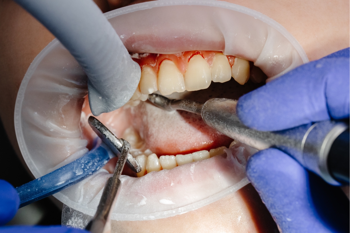 Long-Term Restoration Process in Henderson NV at green valley smile care - brian g sanford dds