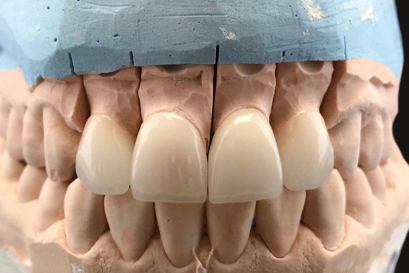 Crowns for teeth