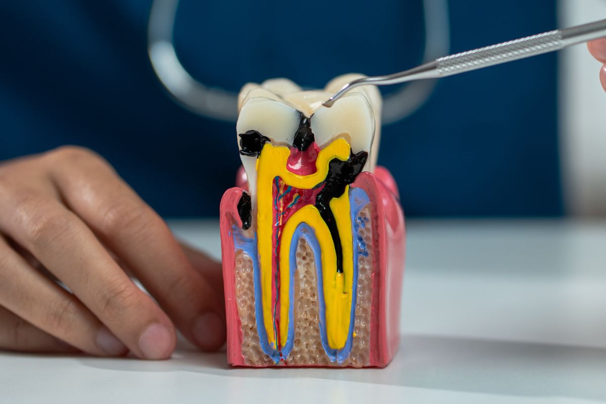 Endodontic Treatment